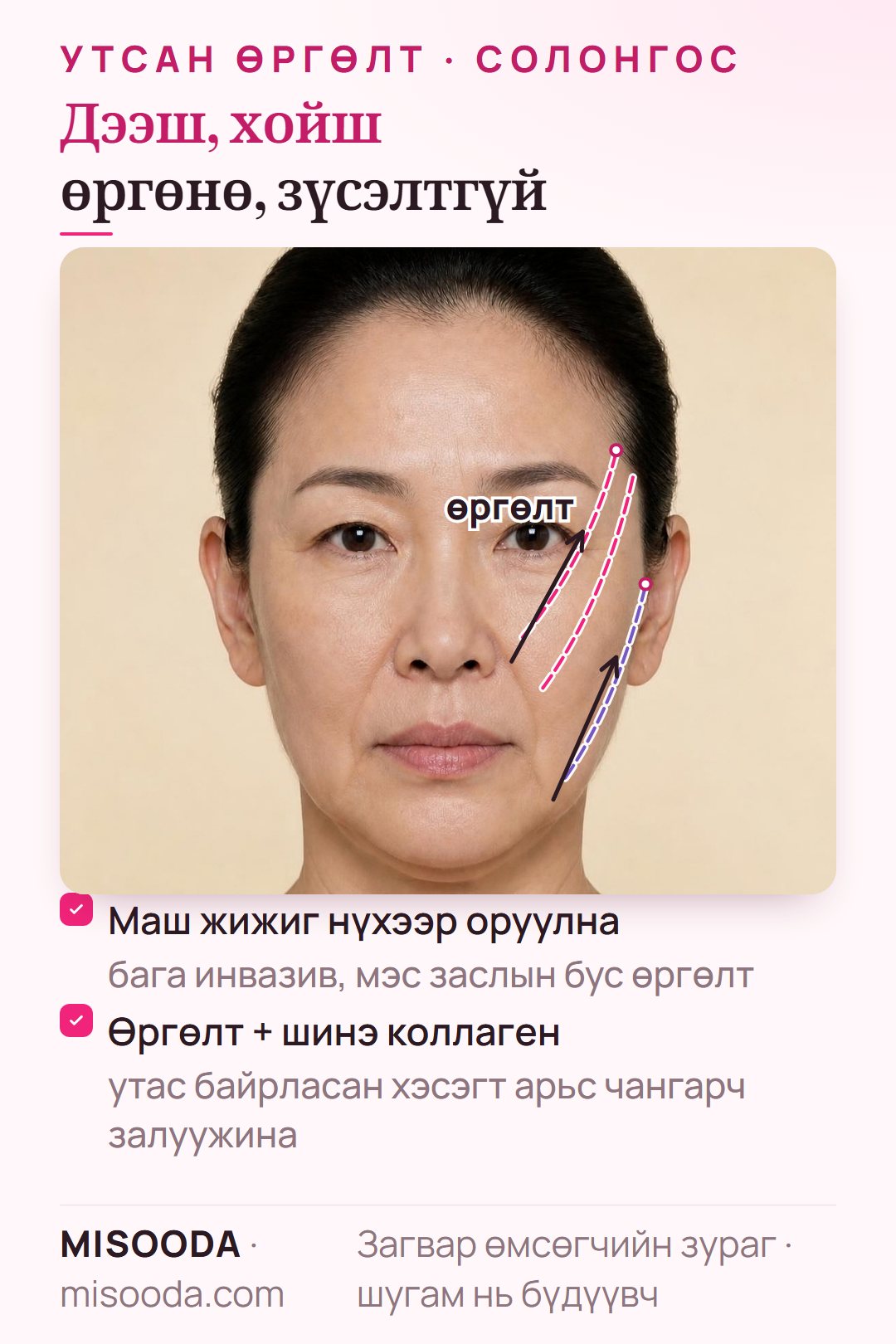 Утсан өргөлтийн чиглэл (нүүрний дөрөвний гурван талаас): чамархай, чихнээс эхэлсэн утас хацар, эрүүний сулралтыг дээш, хойш татаж коллагеныг идэвхжүүлнэ
