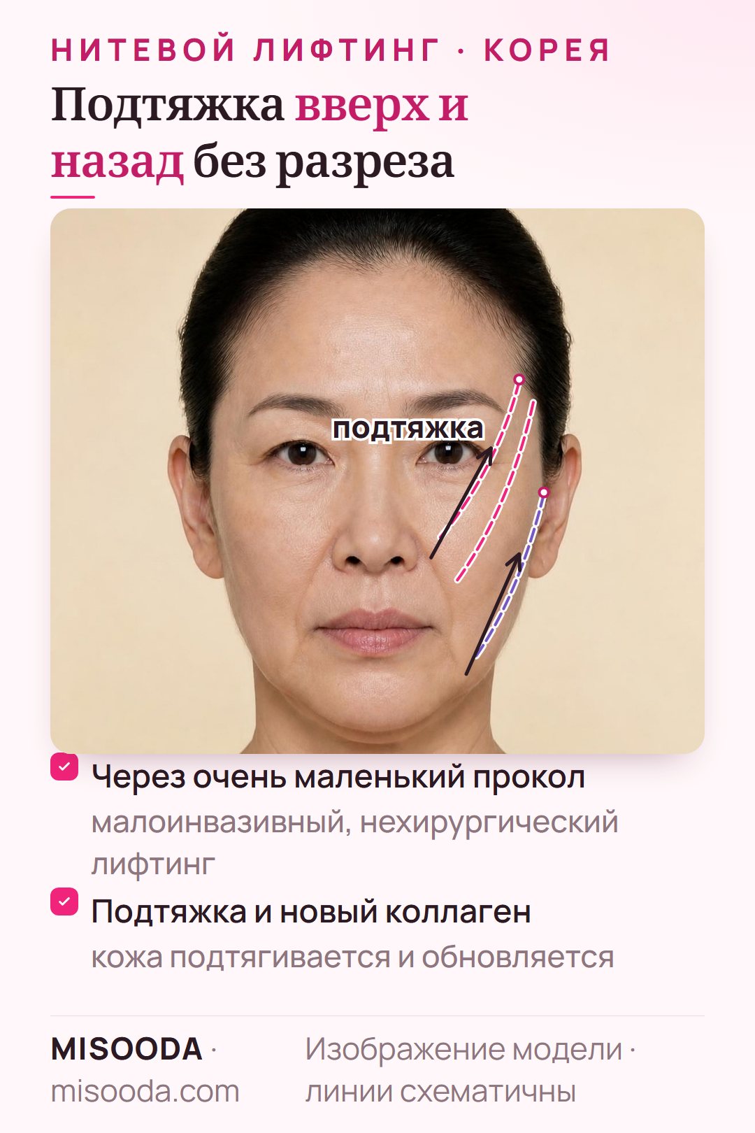 Векторы нитевого лифтинга на лице в три четверти: нити от виска и уха подтягивают щёки и «брыли» вверх и назад и стимулируют коллаген