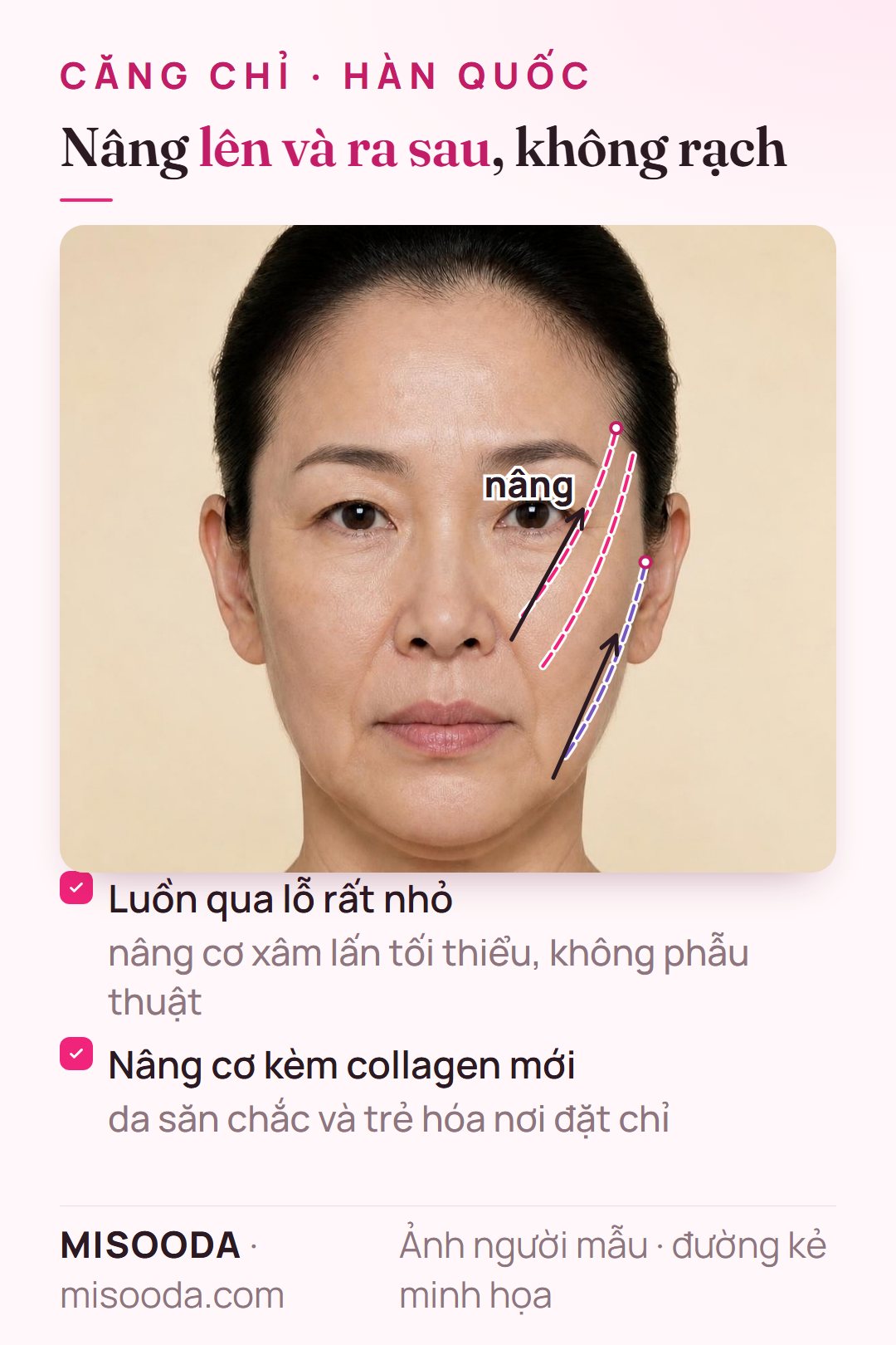 Hướng nâng của căng chỉ trên gương mặt nghiêng: chỉ từ thái dương và tai kéo má và chảy xệ hàm lên và ra sau, đồng thời kích thích collagen