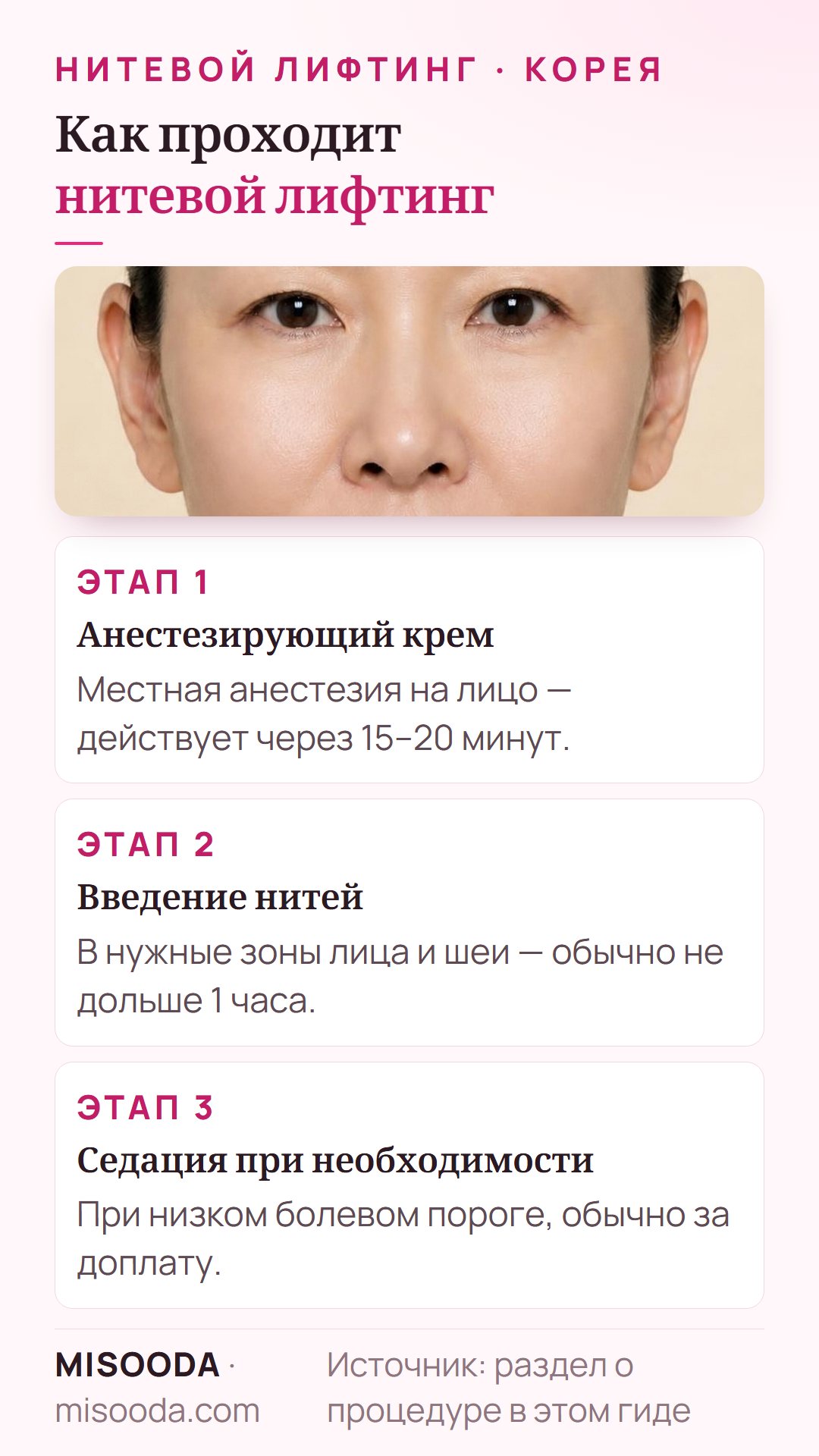 Как проходит нитевой лифтинг в Корее: анестезирующий крем 15–20 минут, введение нитей в лицо и шею не дольше 1 часа, седация по желанию