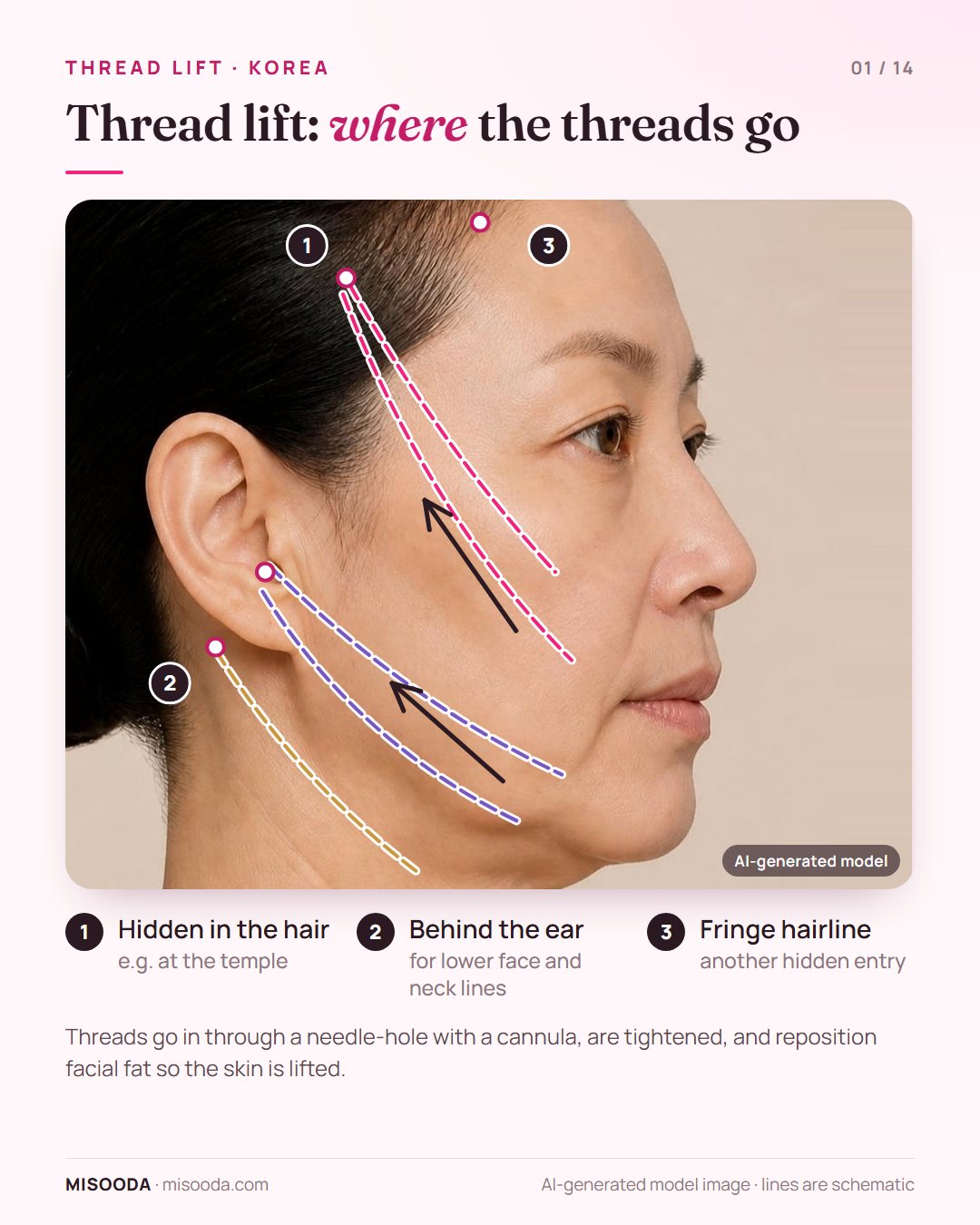 Thread lift paths on a side profile: PDO threads enter in the hair and around the ear and run along the cheek, jawline and neck to lift the skin