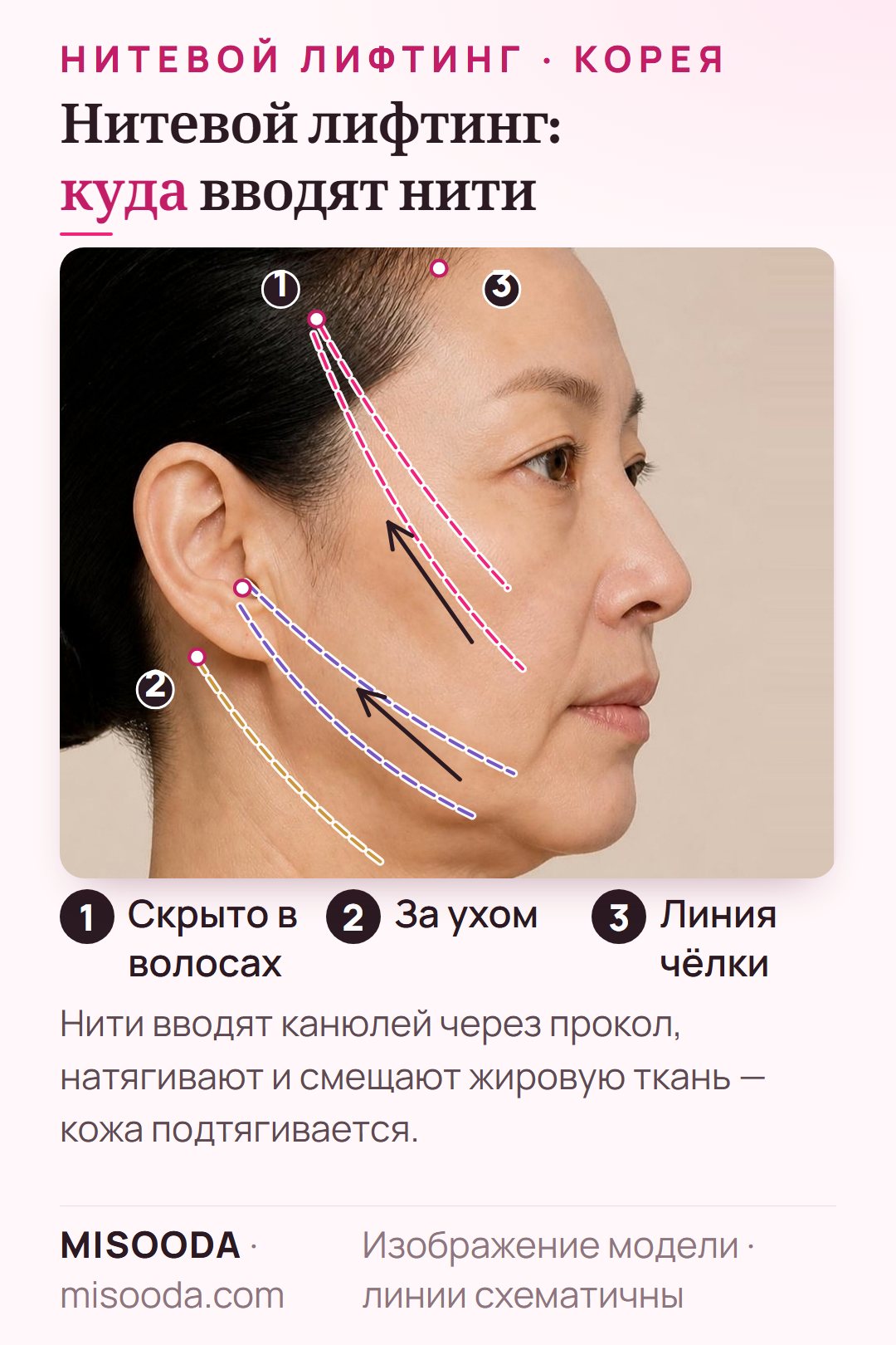 Нитевой лифтинг в Корее: схема нитей в профиль — нити PDO вводят в волосистой части и у уха, они идут вдоль щеки, овала лица и шеи, подтягивая кожу