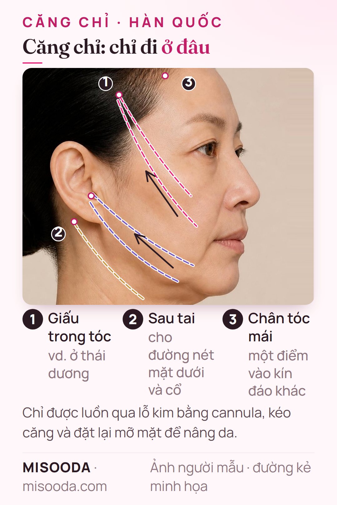 Đường chỉ căng chỉ Hàn Quốc nhìn nghiêng: chỉ PDO luồn vào từ trong tóc và quanh tai, chạy dọc má, đường hàm và cổ để nâng da