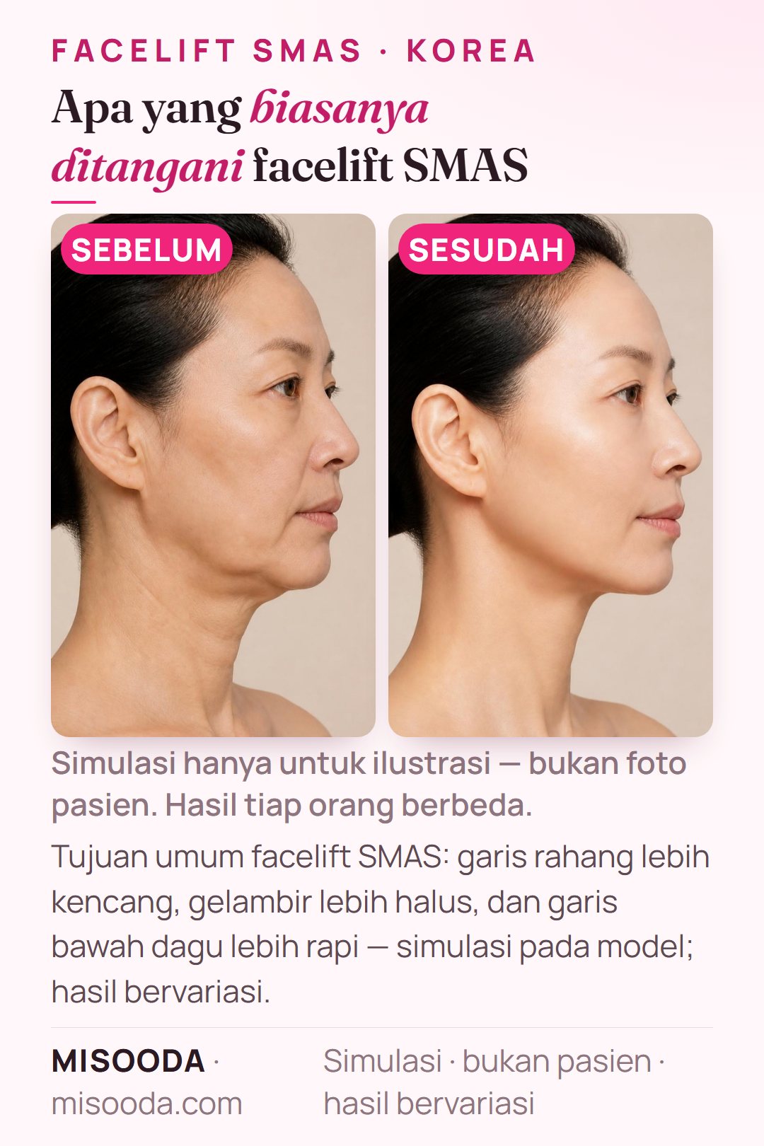 Ilustrasi tujuan umum facelift SMAS di Korea — garis rahang, gelambir, dan garis bawah dagu — disimulasikan pada model, bukan pasien