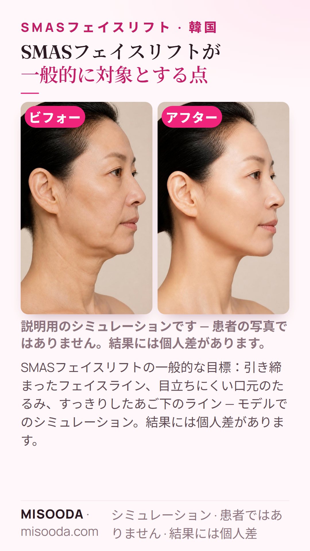 韓国のSMASフェイスリフトが一般的に目指す変化のイラスト — フェイスライン、口元のたるみ、あご下のライン。モデルによるシミュレーションで、患者ではありません