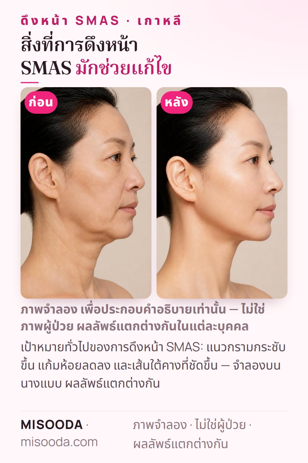 ภาพประกอบเป้าหมายทั่วไปของการดึงหน้า SMAS ที่เกาหลี — แนวกราม แก้มห้อย และเส้นใต้คาง — จำลองบนนางแบบ ไม่ใช่ผู้ป่วย