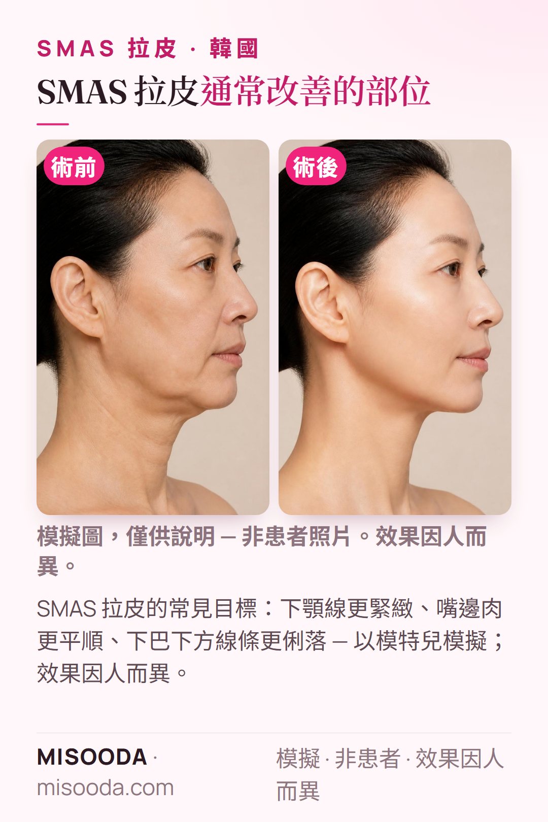 韓國 SMAS 拉皮手術常見目標示意圖 — 下顎線、嘴邊肉與下巴下方線條 — 以模特兒模擬呈現,並非真實患者照片,僅供了解手術希望改善的方向