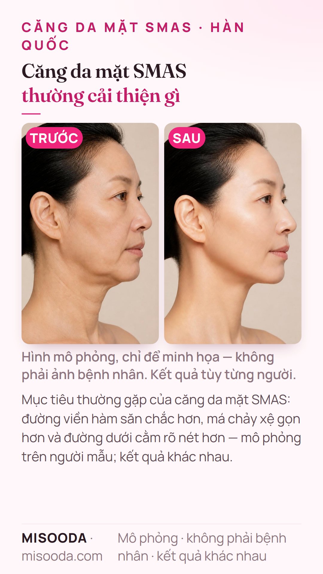 Minh họa mục tiêu thường gặp của căng da mặt SMAS tại Hàn Quốc — đường viền hàm, má chảy xệ và đường dưới cằm — mô phỏng trên người mẫu, không phải bệnh nhân