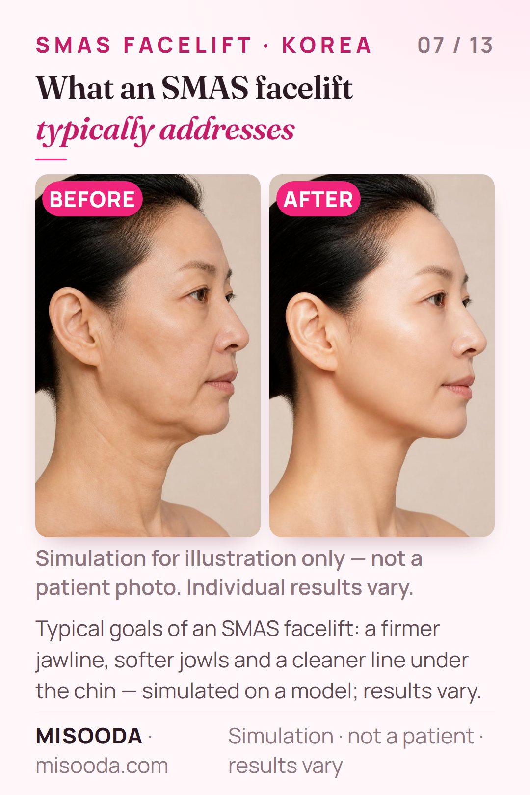 Illustration of the typical goals of an SMAS facelift in Korea — jawline, jowls and the line under the chin — simulated on a model, not a patient