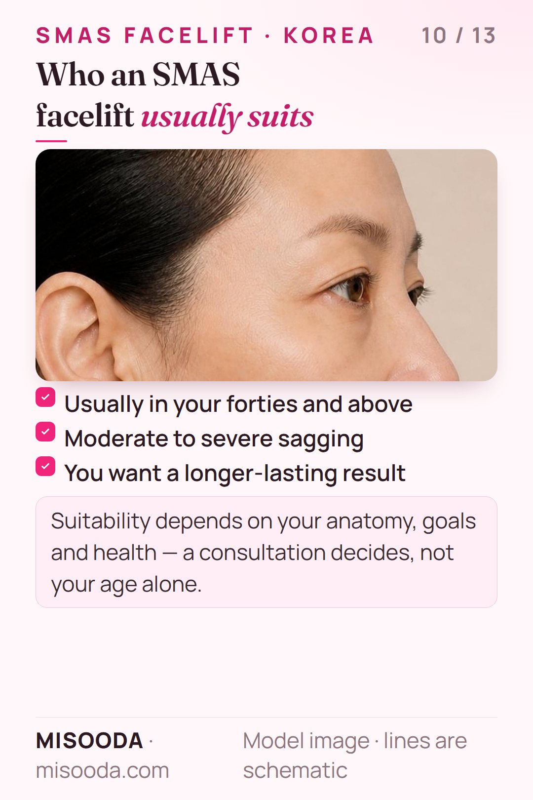 Who suits an SMAS facelift: usually 40s and above, moderate to severe sagging, wanting a longer-lasting result