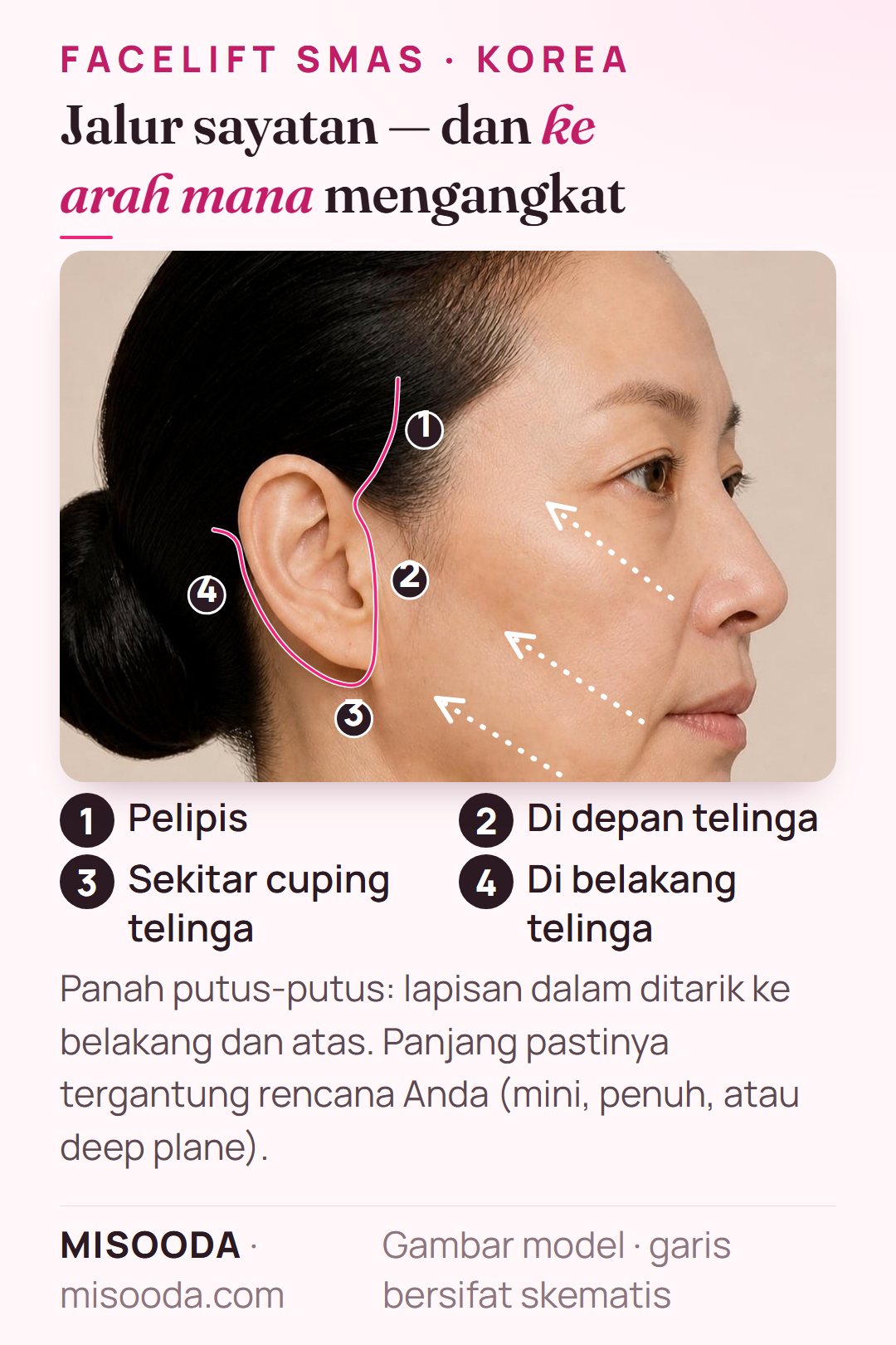 Jalur sayatan facelift SMAS di Korea: garis rambut pelipis, depan telinga, sekitar cuping telinga, dan belakang telinga, dengan arah angkat ke belakang dan atas