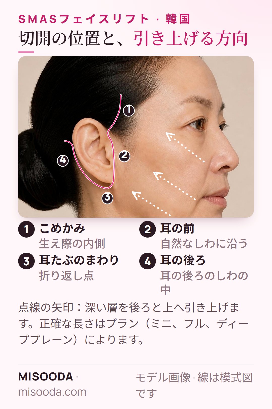 韓国 SMASフェイスリフトの切開位置:こめかみの生え際、耳の前、耳たぶのまわり、耳の後ろ、そして後ろと上への引き上げ方向
