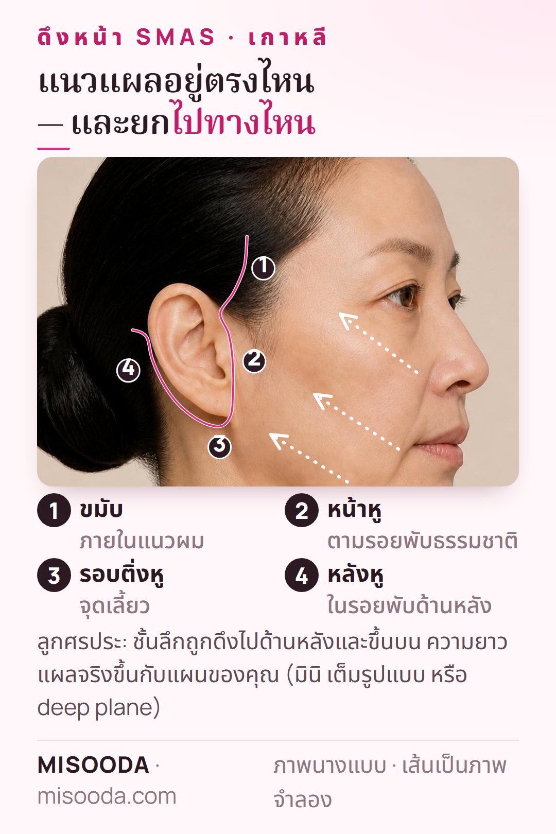 แนวแผลดึงหน้า SMAS เกาหลี: แนวผมขมับ หน้าหู รอบติ่งหู และหลังหู พร้อมทิศทางการยกไปด้านหลังและขึ้นบน