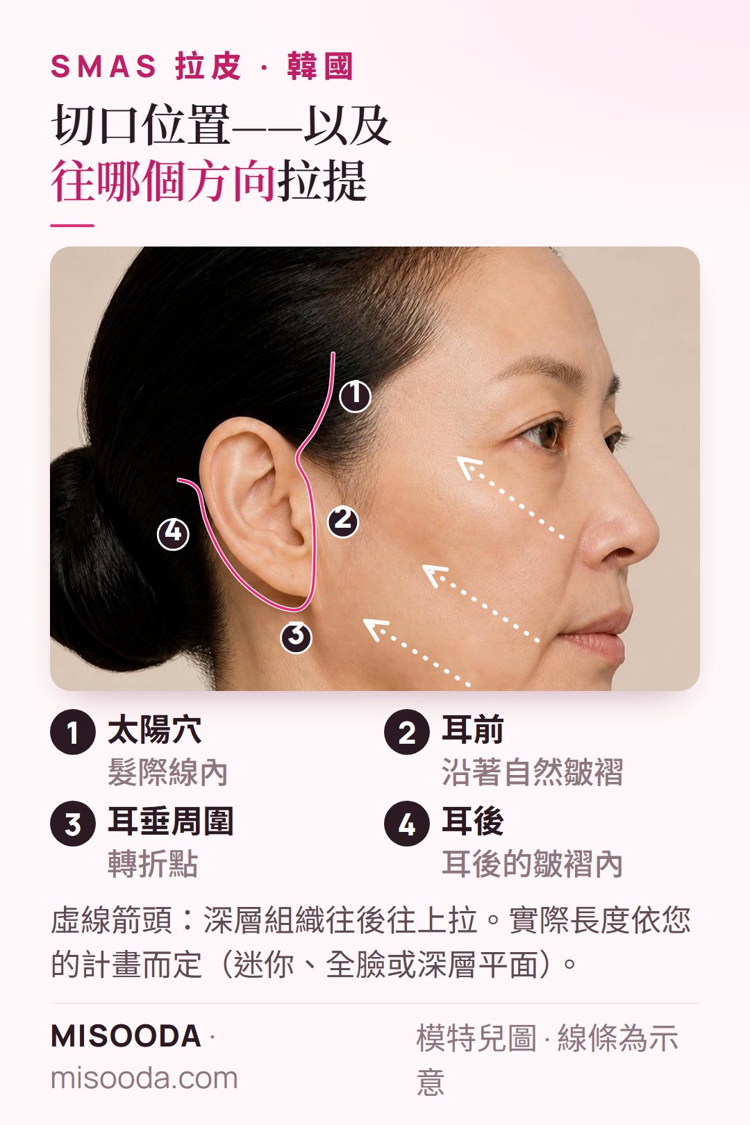 韓國 SMAS 拉皮切口路徑:太陽穴髮際線、耳前、耳垂周圍與耳後,並畫出往後往上的拉提方向