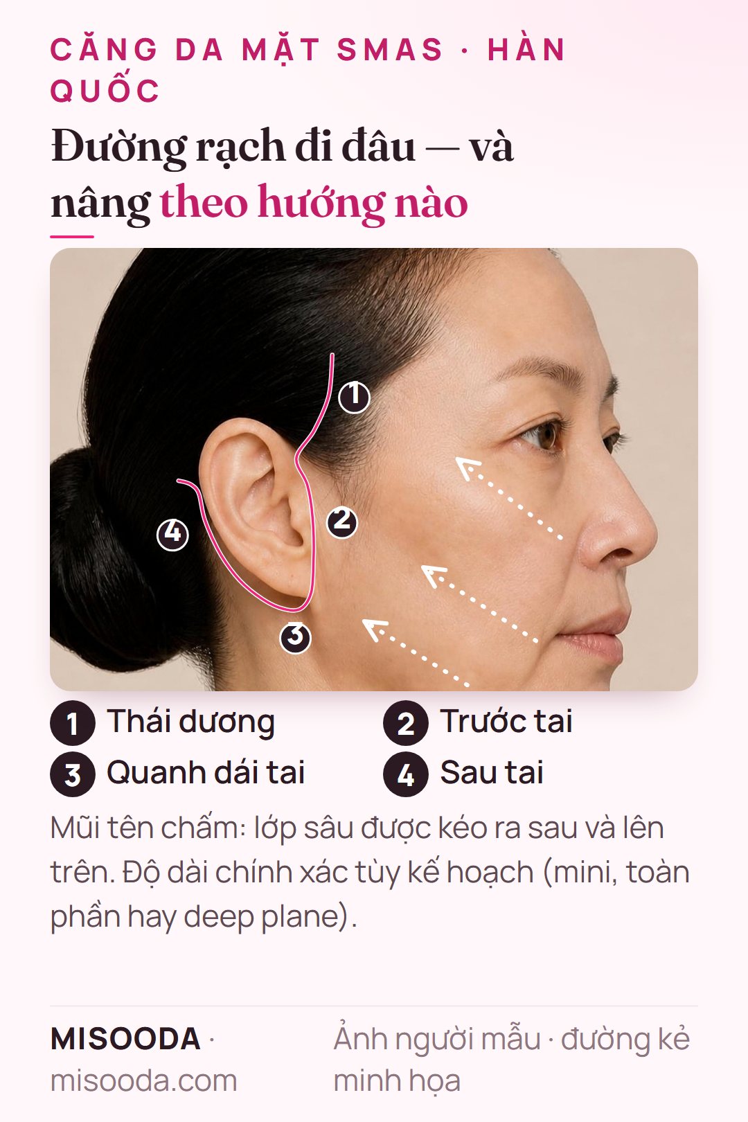 Đường rạch căng da mặt SMAS Hàn Quốc: chân tóc thái dương, trước tai, quanh dái tai và sau tai, với hướng nâng ra sau và lên trên