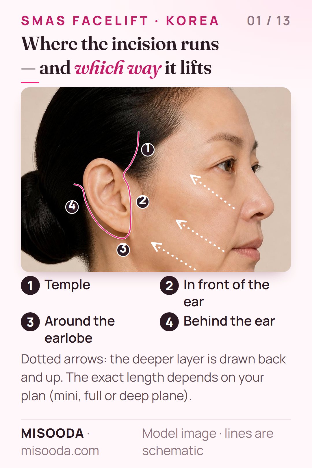 SMAS facelift incision path in Korea: temple hairline, in front of the ear, around the earlobe and behind the ear, with the lift drawn back and up