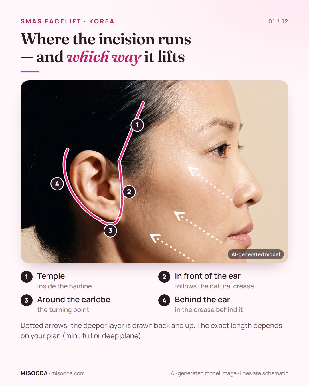 SMAS facelift incision path in Korea: temple hairline, in front of the ear, around the earlobe and behind the ear, with the lift drawn back and up