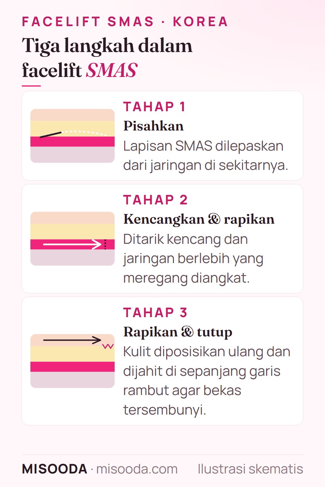 Tiga langkah facelift SMAS: pisahkan lapisan SMAS, kencangkan dan rapikan kelebihannya, lalu rapikan kulit dan tutup di sepanjang garis rambut