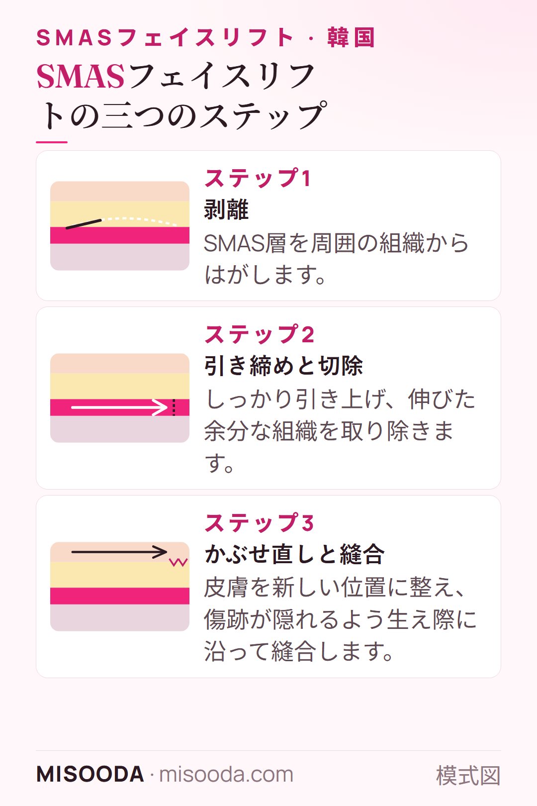 SMASフェイスリフトの三つのステップ:SMAS層を剥離、引き締めて余分を切除、皮膚をかぶせ直して生え際に沿って縫合 — 韓国 フェイスリフト