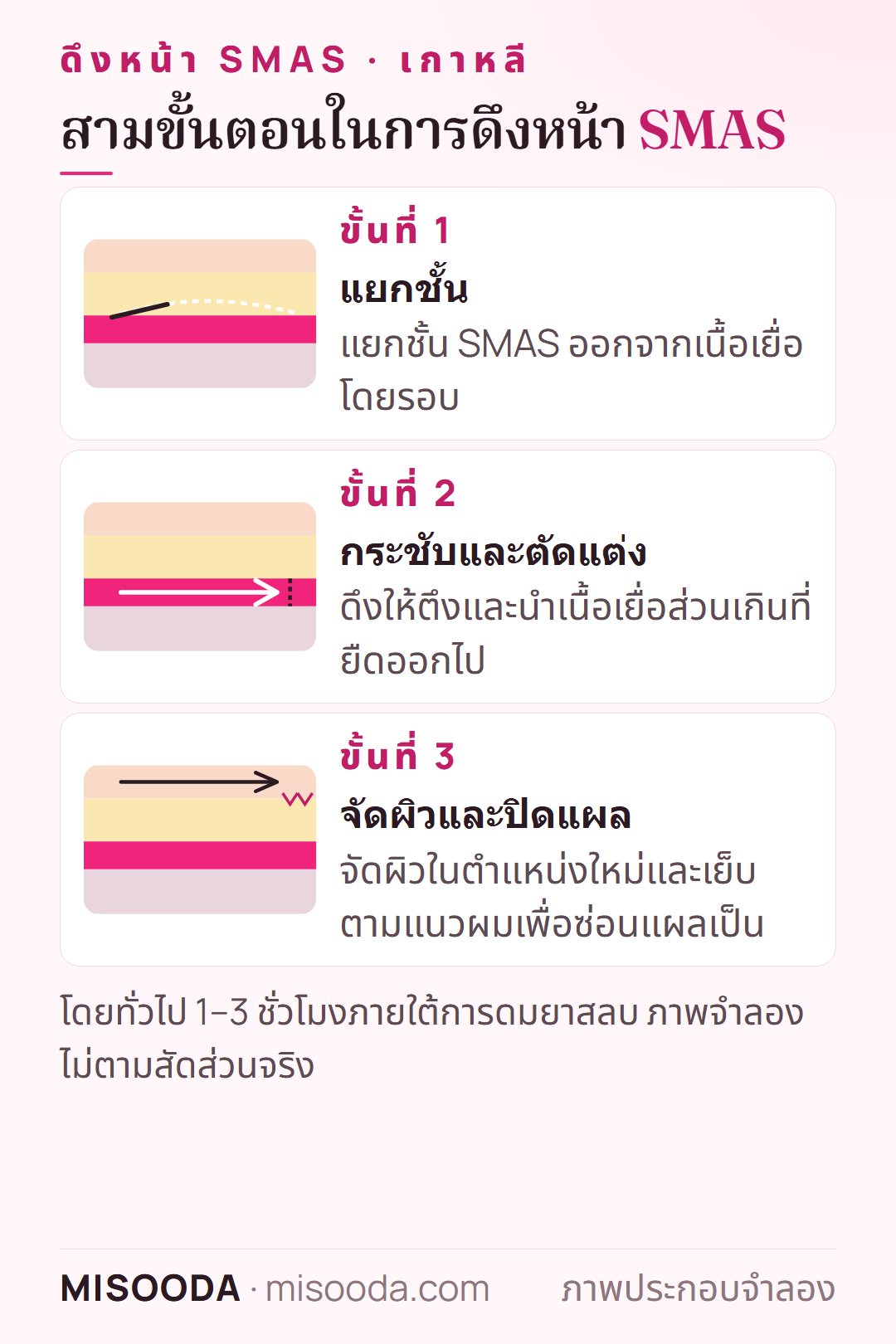 สามขั้นตอนของการดึงหน้า SMAS เกาหลี: แยกชั้น SMAS กระชับและตัดส่วนเกิน จัดผิวใหม่และปิดแผลตามแนวผม