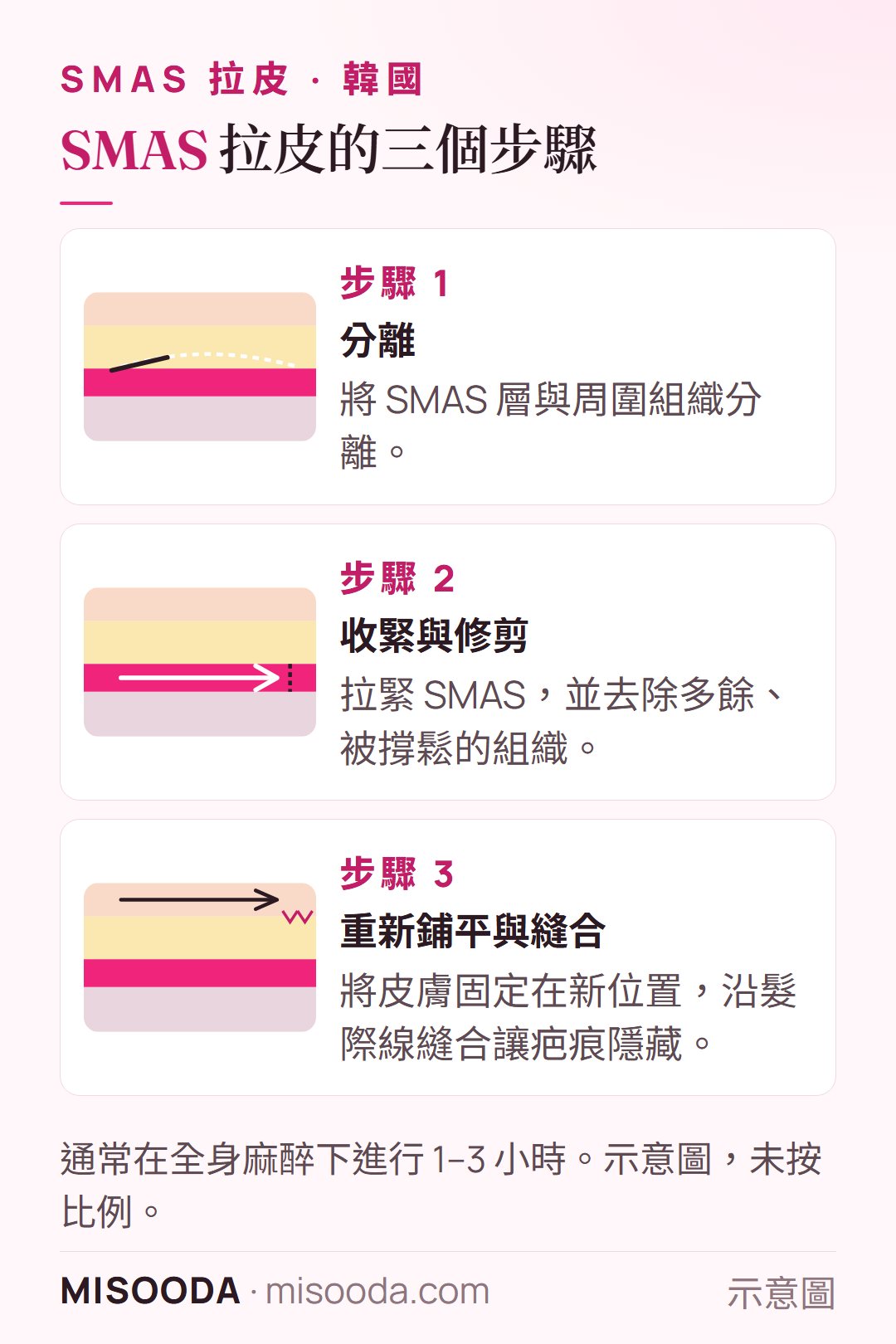 韓國 SMAS 拉皮的三個步驟:分離 SMAS 層、收緊並修剪多餘組織、重新鋪平皮膚並沿髮際線縫合