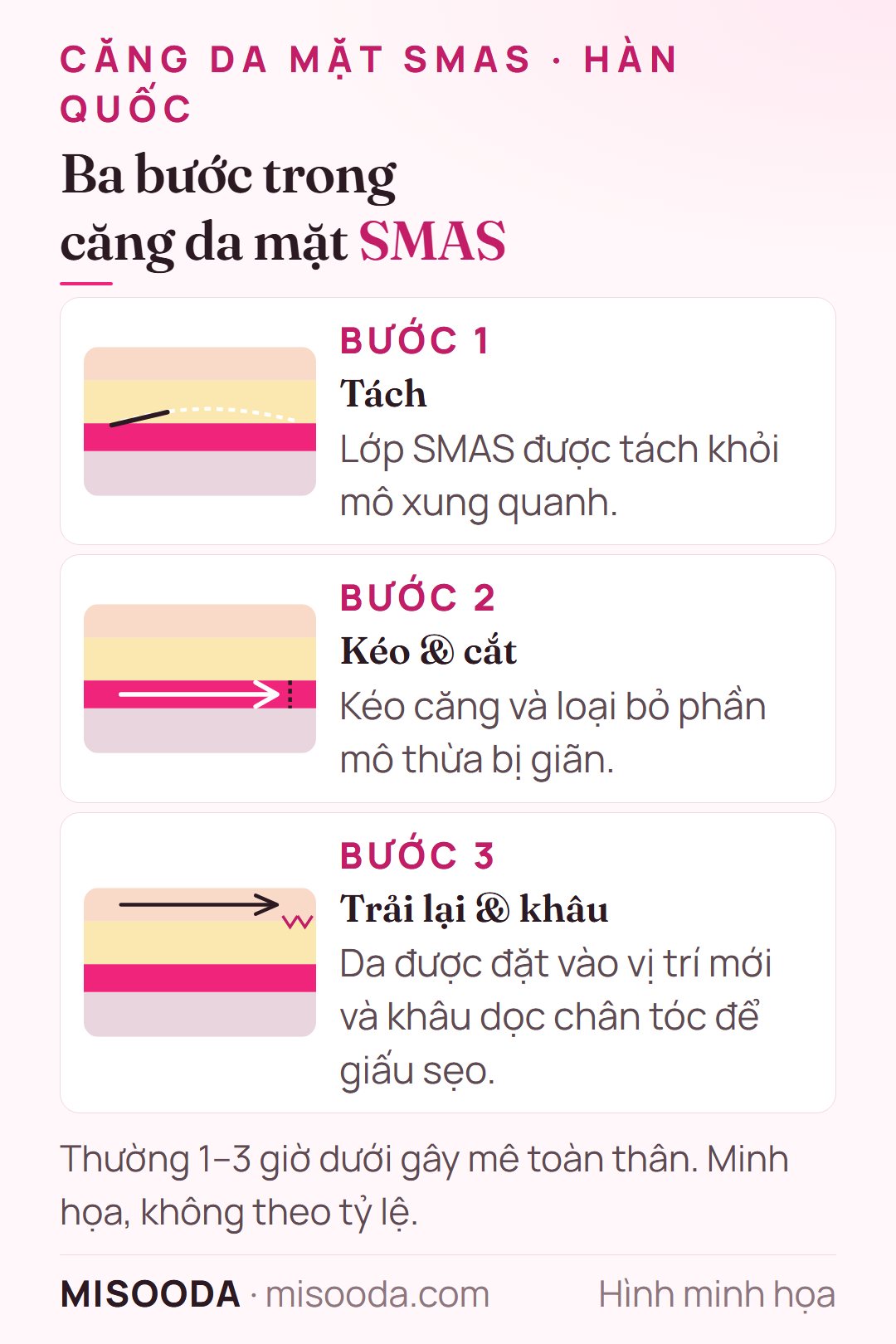 Ba bước căng da mặt SMAS: tách lớp SMAS, kéo căng và cắt bỏ phần thừa, trải lại da và khâu dọc chân tóc