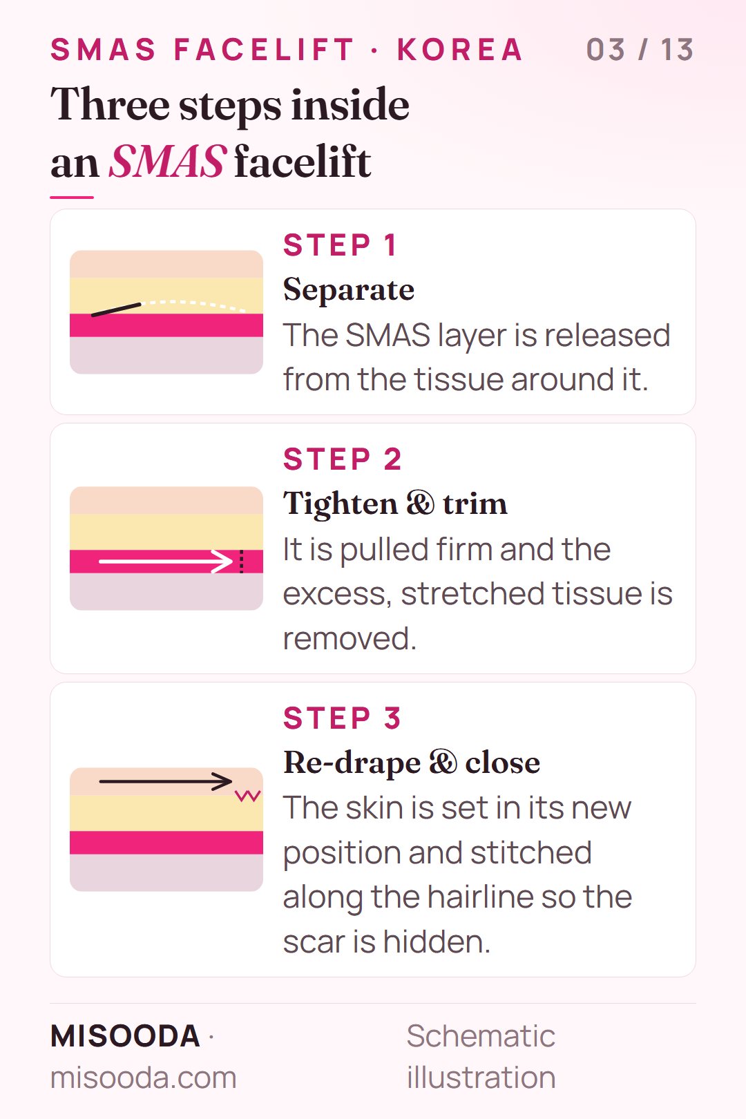 Three steps of an SMAS facelift: separate the SMAS layer, tighten and trim the excess, re-drape the skin and close along the hairline