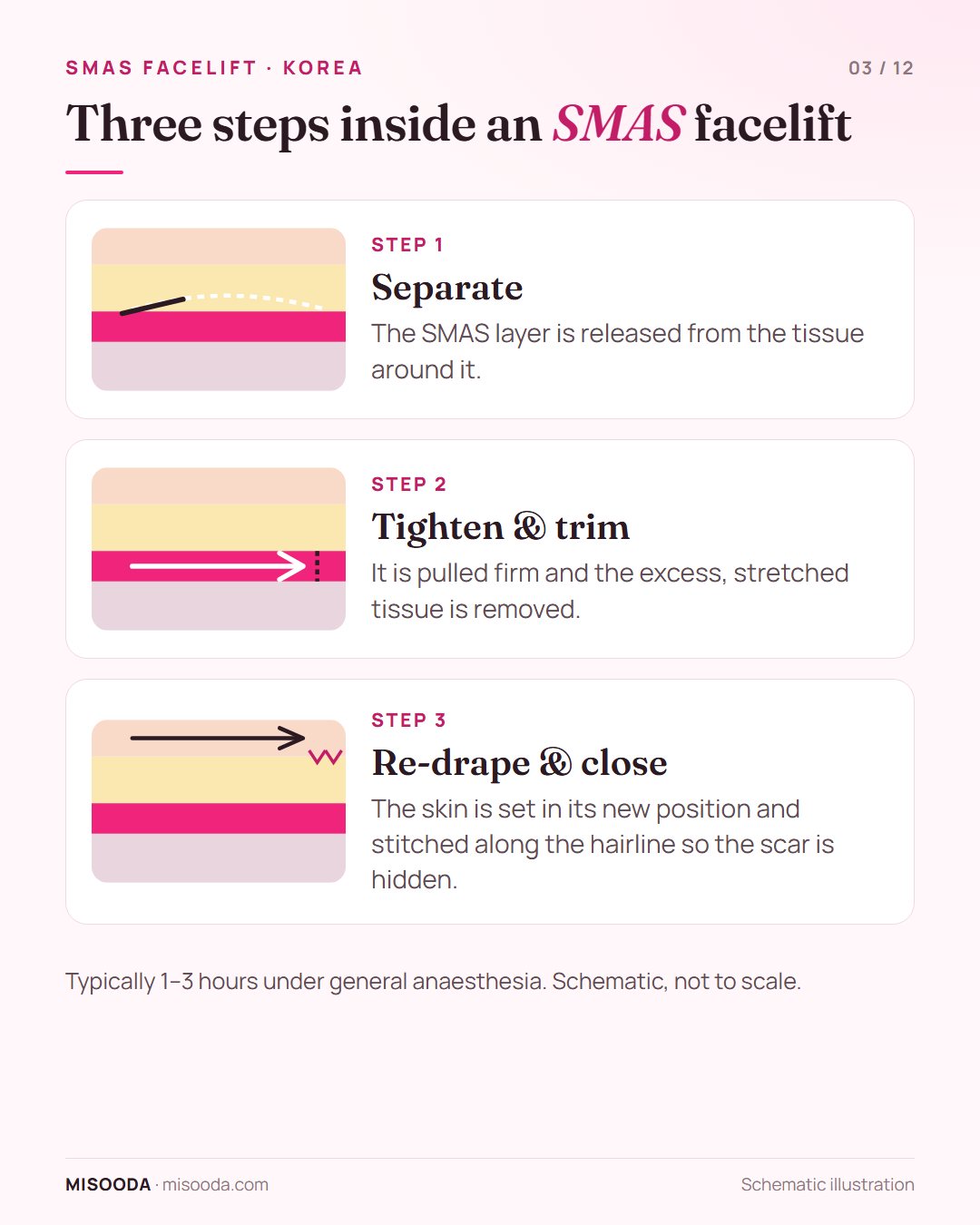 Three steps of an SMAS facelift: separate the SMAS layer, tighten and trim the excess, re-drape the skin and close along the hairline