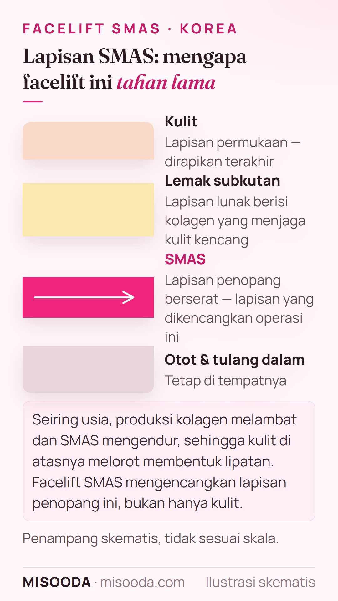 Penampang lapisan wajah — kulit, lemak subkutan, lapisan penopang SMAS, dan otot dalam — menunjukkan SMAS yang dikencangkan pada facelift di Korea