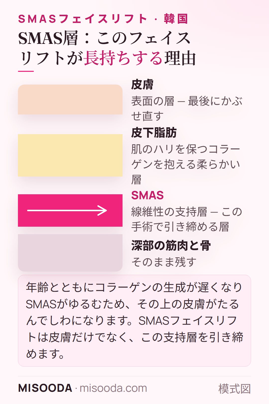 顔の層の断面図 — 皮膚、皮下脂肪、SMAS支持層、深部の筋肉 — フェイスリフトでSMASを引き締める様子 — 韓国 フェイスリフト