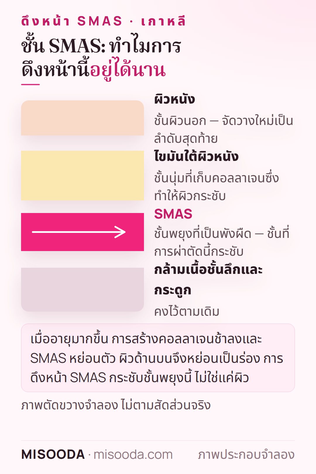ภาพตัดขวางชั้นใบหน้า ดึงหน้า SMAS เกาหลี — ผิวหนัง ไขมันใต้ผิว ชั้นพยุง SMAS และกล้ามเนื้อชั้นลึก — แสดงการกระชับ SMAS ในการดึงหน้า
