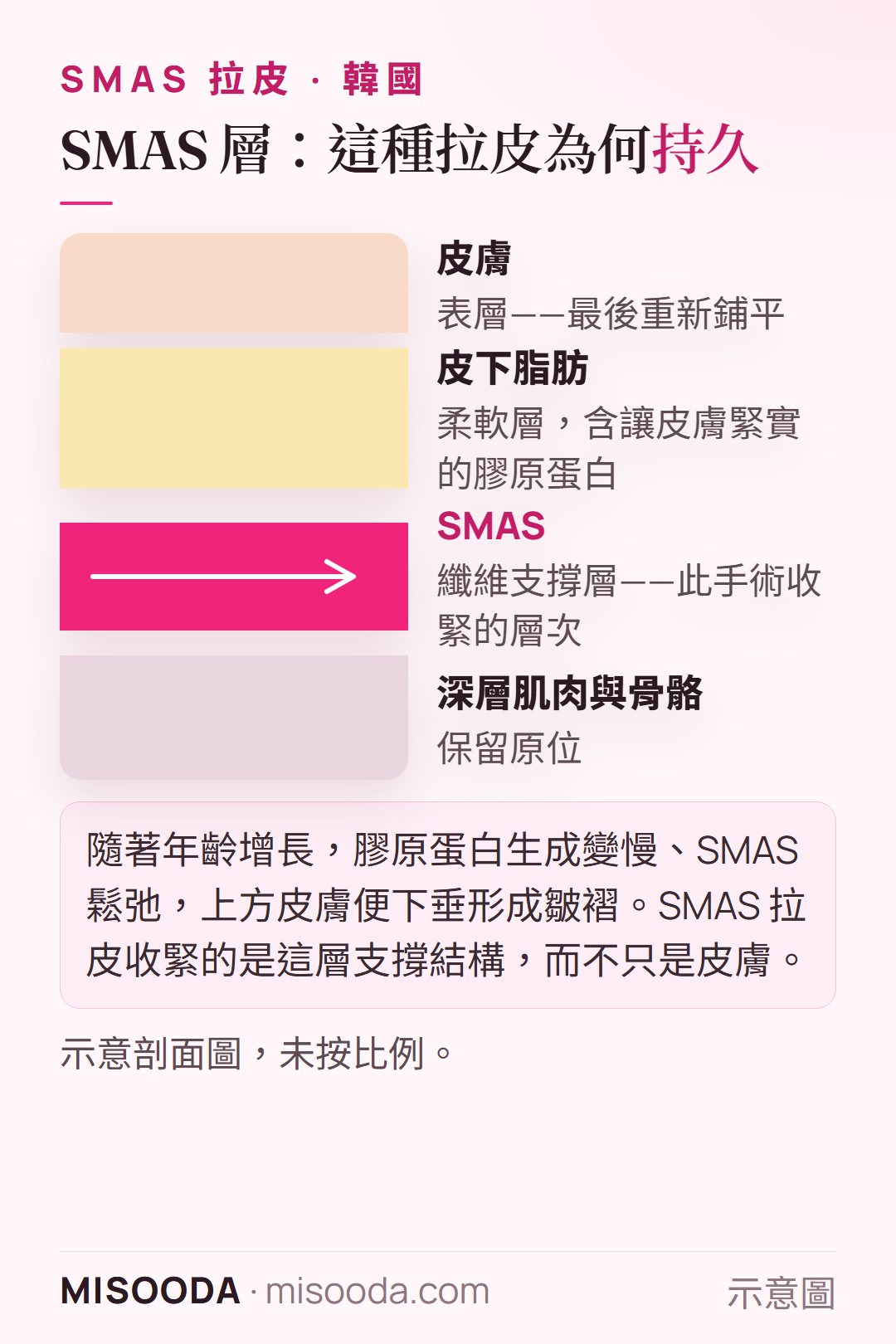 韓國 SMAS 拉皮臉部層次剖面圖——皮膚、皮下脂肪、SMAS 支撐層與深層肌肉——呈現拉皮時收緊 SMAS