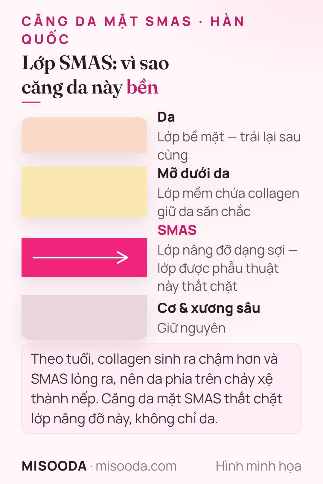 Mặt cắt các lớp mặt — da, mỡ dưới da, lớp nâng đỡ SMAS và cơ sâu — cho thấy SMAS được thắt chặt khi căng da mặt