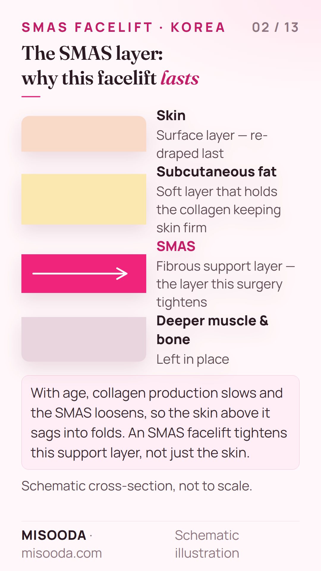 Cross-section of facial layers — skin, subcutaneous fat, SMAS support layer and deeper muscle — showing the SMAS tightened in a facelift