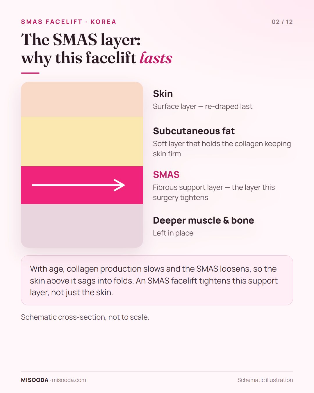 Cross-section of facial layers — skin, subcutaneous fat, SMAS support layer and deeper muscle — showing the SMAS tightened in a facelift