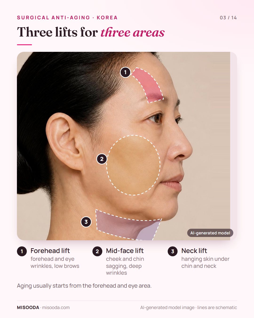 Surgical anti-aging lift areas on a side profile: forehead lift for the brow and eyes, mid-face lift for cheek and chin, neck lift for the neck