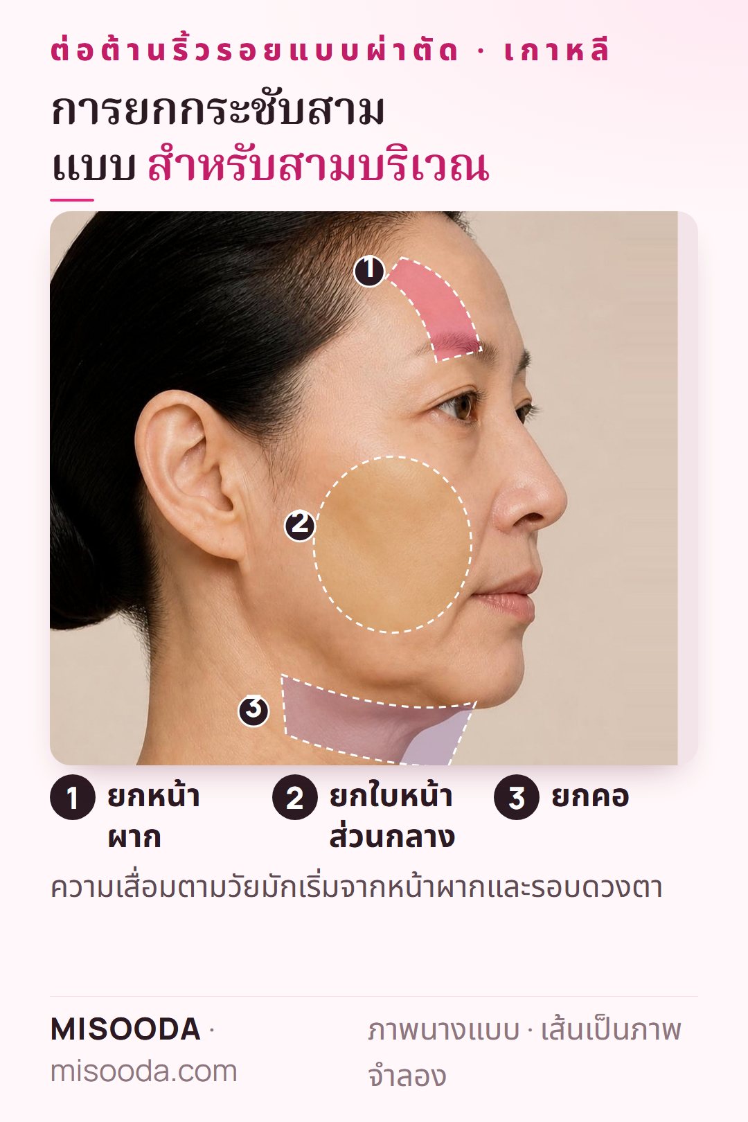 บริเวณยกกระชับแบบผ่าตัด เกาหลี ในมุมด้านข้าง: ยกหน้าผากสำหรับคิ้วและตา ยกใบหน้าส่วนกลางสำหรับแก้มและคาง ยกคอสำหรับลำคอ