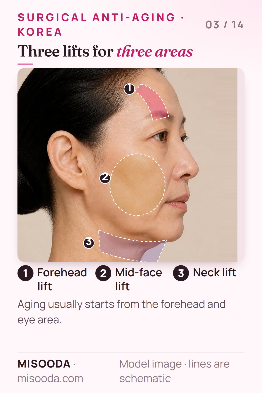 Surgical anti-aging lift areas on a side profile: forehead lift for the brow and eyes, mid-face lift for cheek and chin, neck lift for the neck
