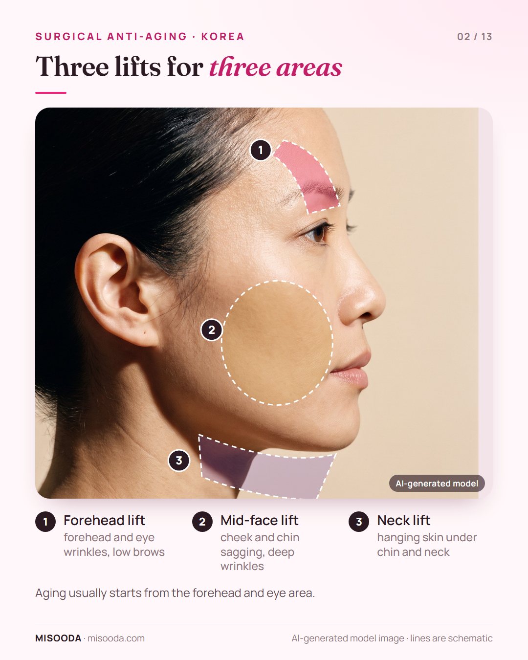 Surgical anti-aging lift areas on a side profile: forehead lift for the brow and eyes, mid-face lift for cheek and chin, neck lift for the neck