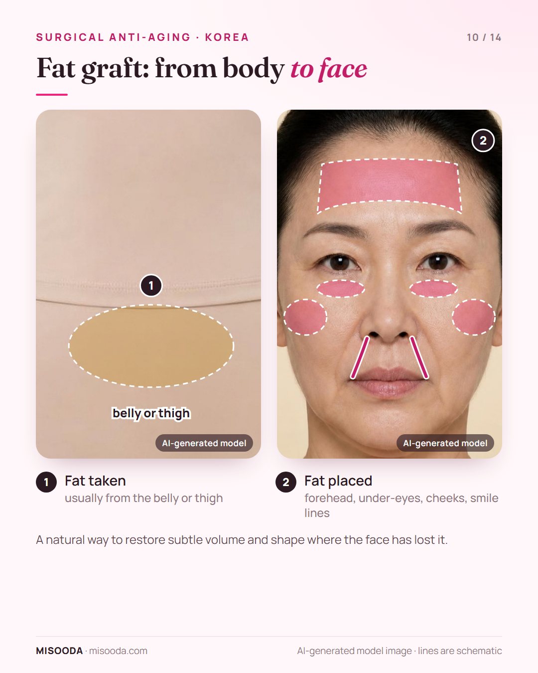 Facial fat grafting: fat taken from the belly or thigh and transferred to the forehead, under-eye hollows, cheeks and deep smile lines