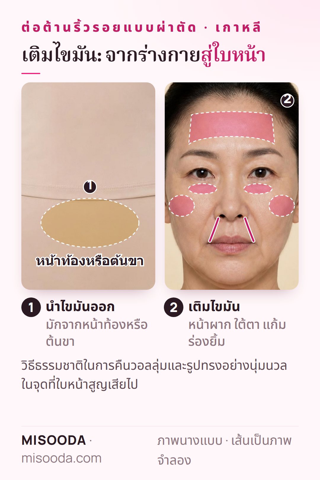 เติมไขมันใบหน้า เกาหลี: นำไขมันจากหน้าท้องหรือต้นขา ย้ายไปที่หน้าผาก ใต้ตาที่ลึก แก้ม และร่องยิ้มลึก