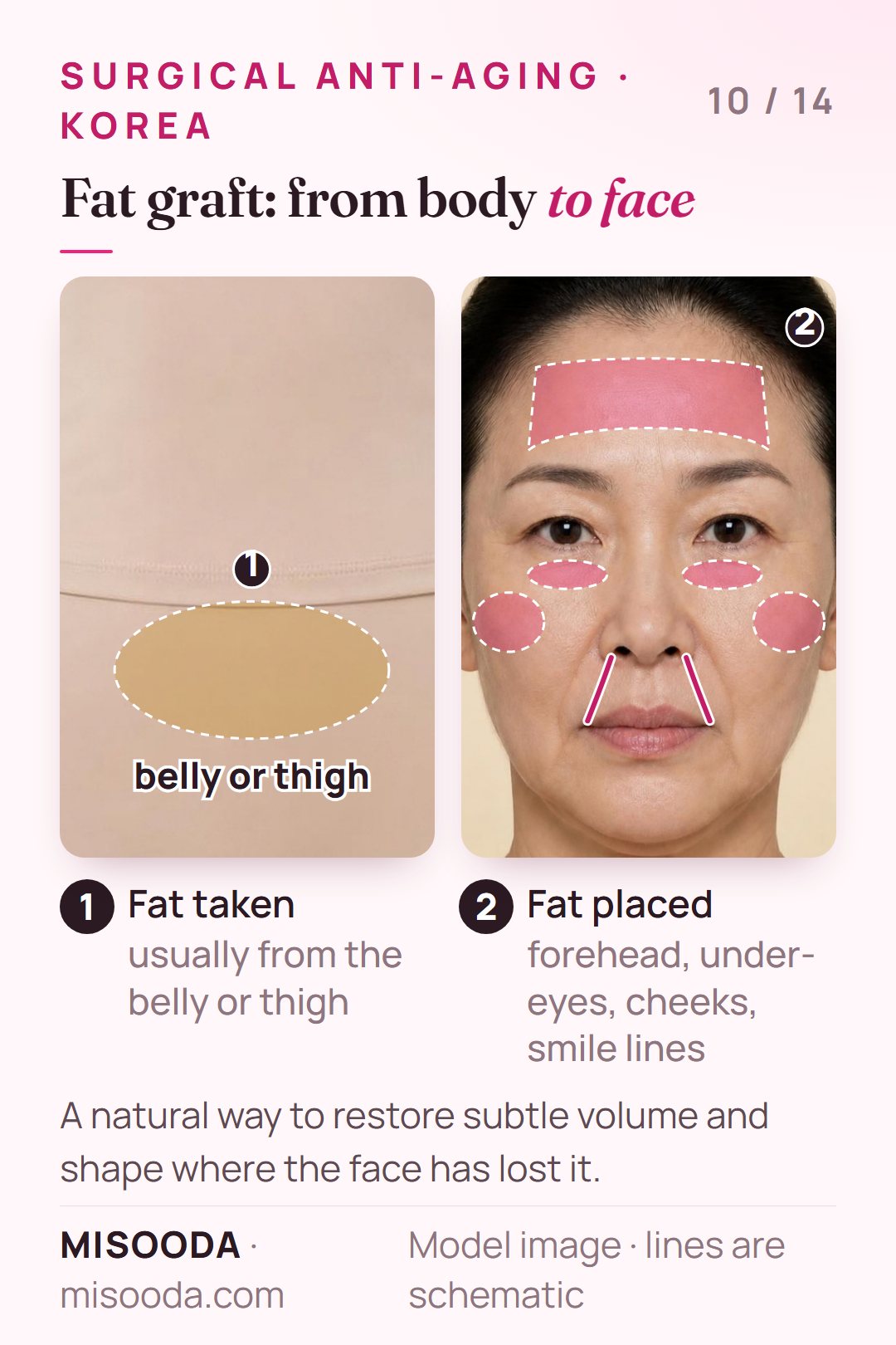 Facial fat grafting: fat taken from the belly or thigh and transferred to the forehead, under-eye hollows, cheeks and deep smile lines