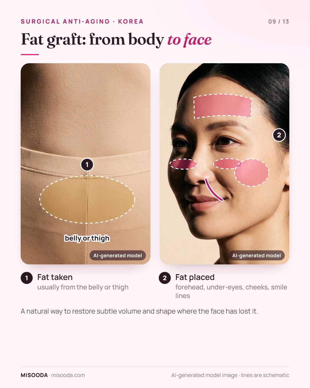 Facial fat grafting: fat taken from the belly or thigh and transferred to the forehead, under-eye hollows, cheeks and deep smile lines