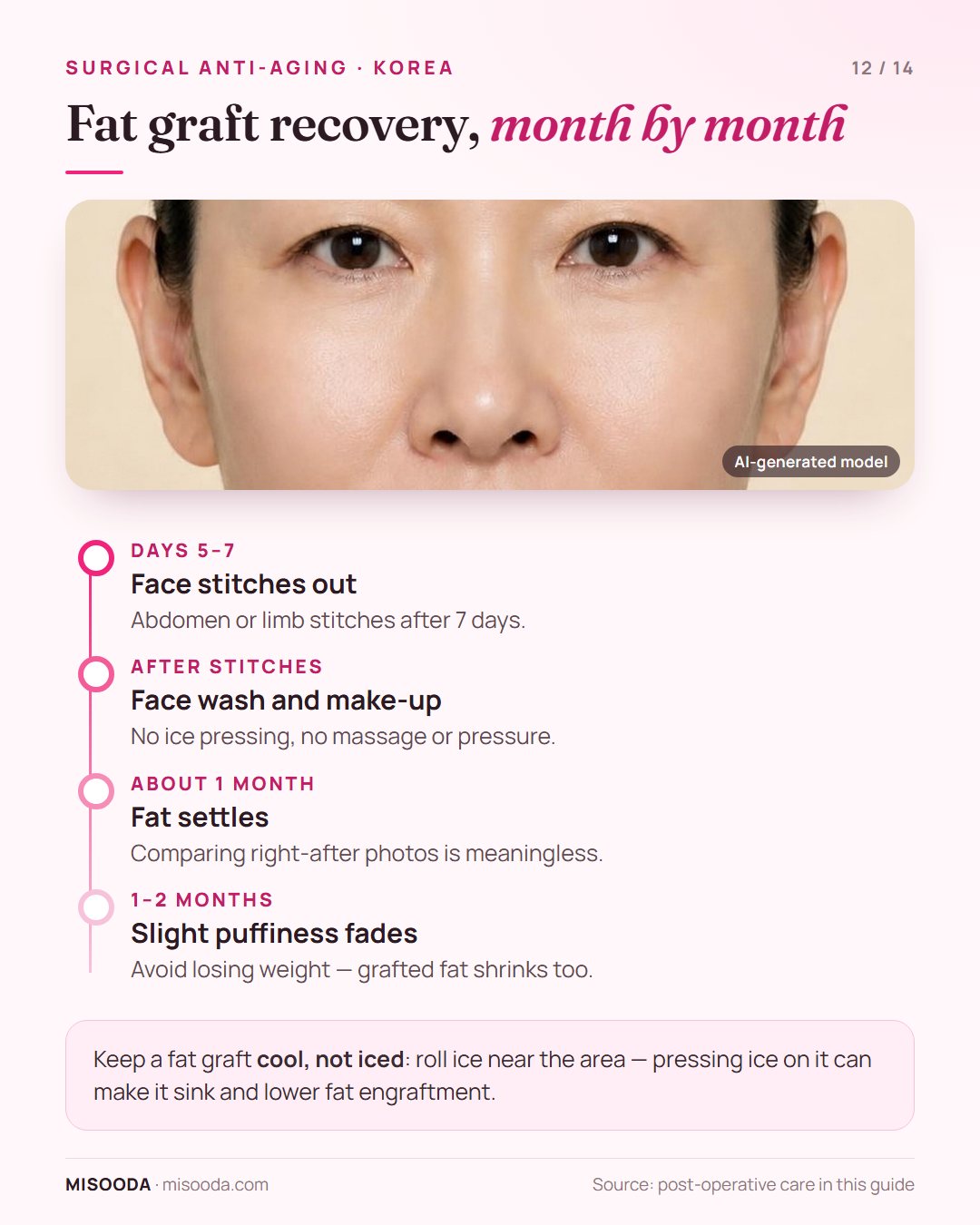 Fat graft recovery timeline: face stitches out at 5–7 days, fat settles in about 1 month, slight puffiness for 1–2 months, avoid weight loss