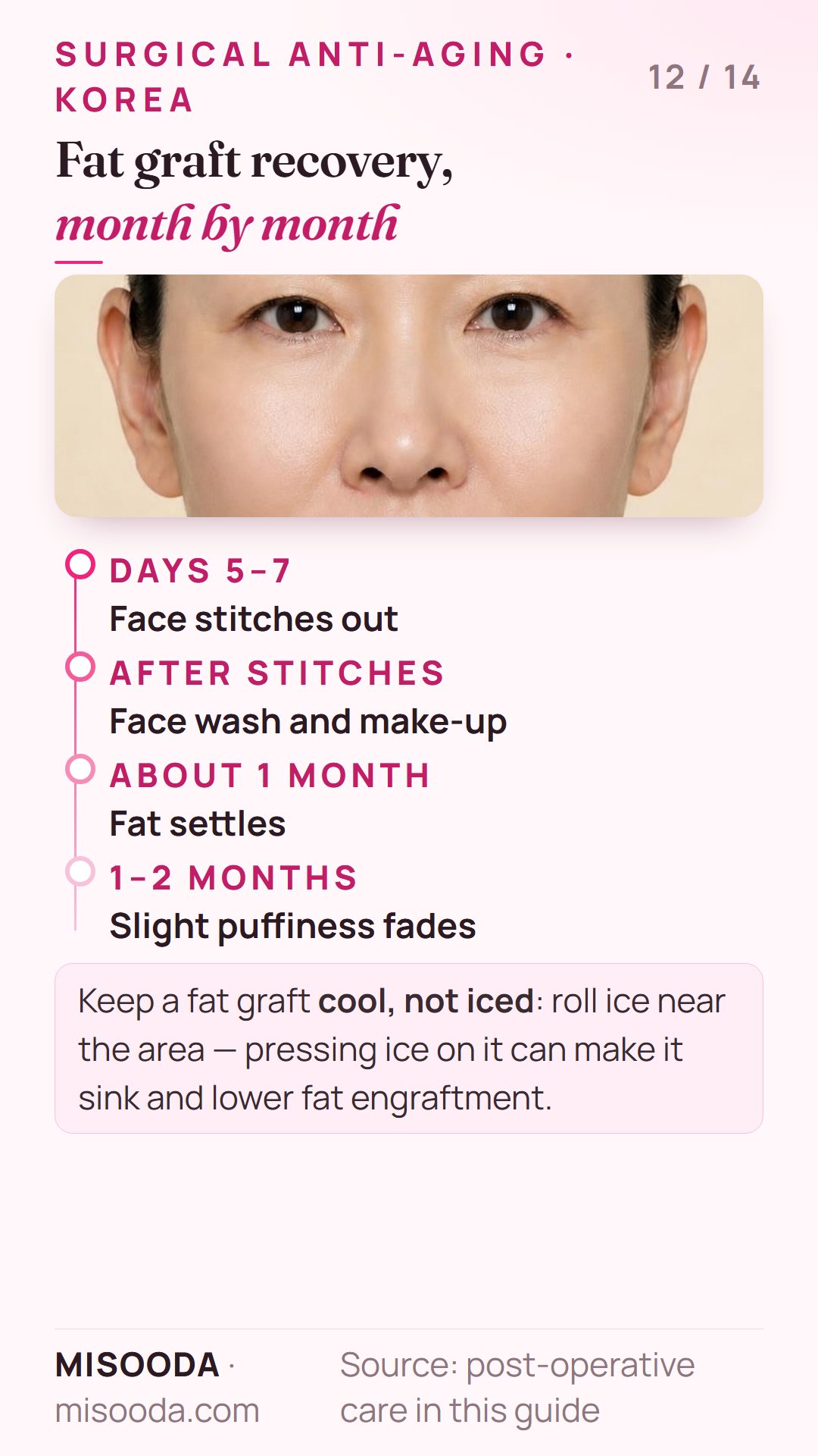 Fat graft recovery timeline: face stitches out at 5–7 days, fat settles in about 1 month, slight puffiness for 1–2 months, avoid weight loss