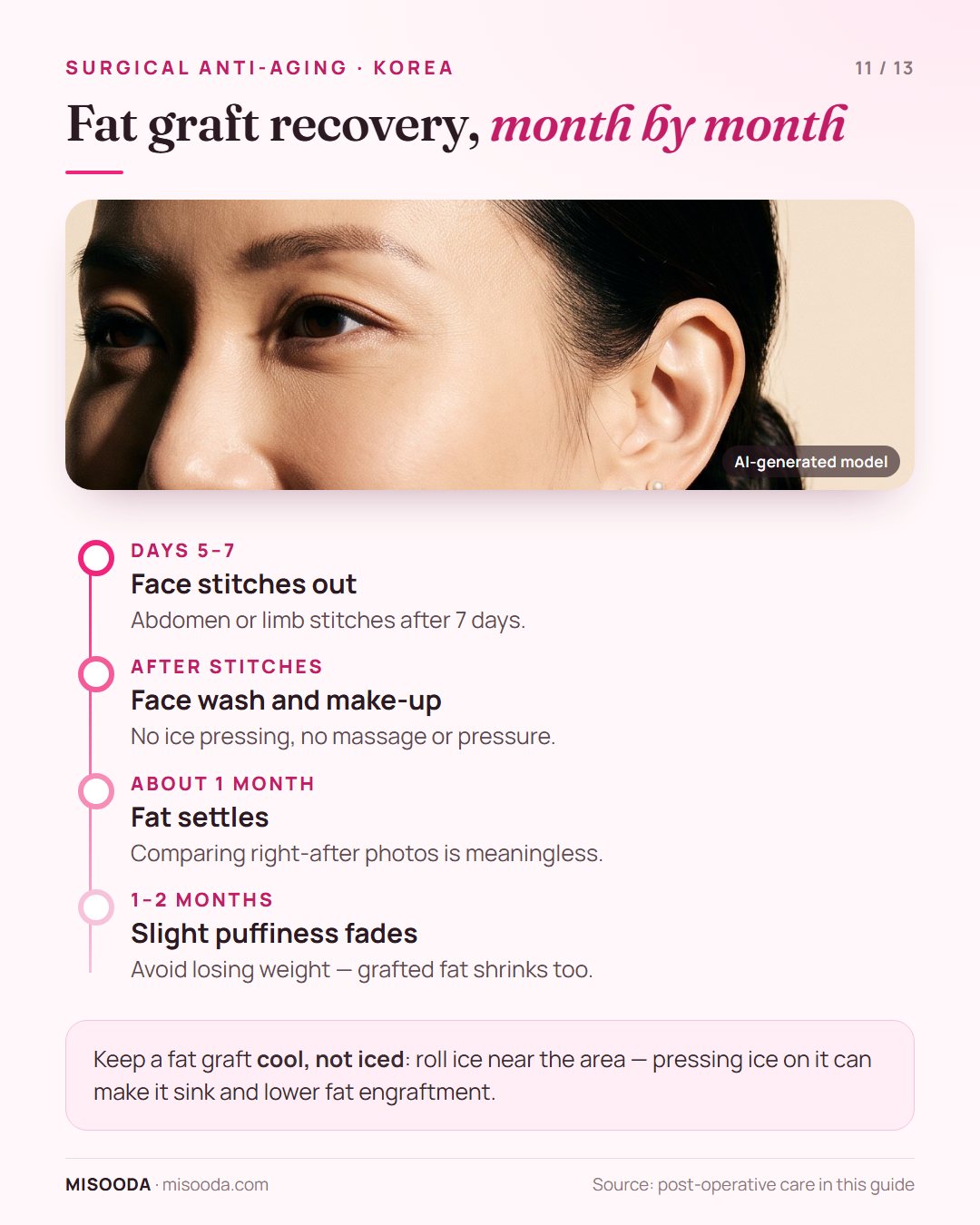 Fat graft recovery timeline: face stitches out at 5–7 days, fat settles in about 1 month, slight puffiness for 1–2 months, avoid weight loss
