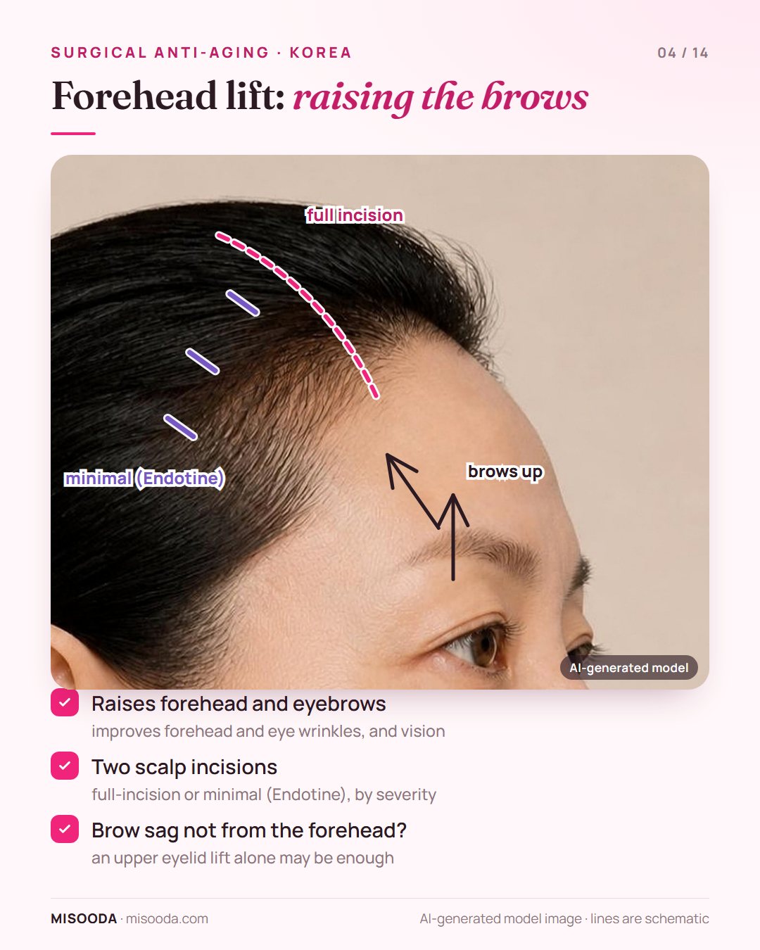 Forehead lift in Korea: full-incision or minimal Endotine incisions on the scalp raise the forehead and eyebrows to improve wrinkles and vision