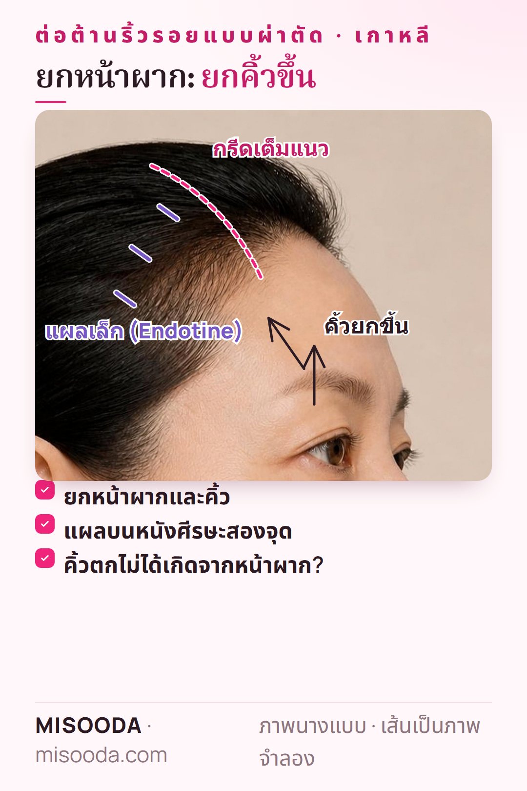 ยกหน้าผาก เกาหลี: แผลบนหนังศีรษะแบบกรีดเต็มแนวหรือแผลเล็ก Endotine ยกหน้าผากและคิ้วเพื่อลดริ้วรอยและช่วยการมองเห็น