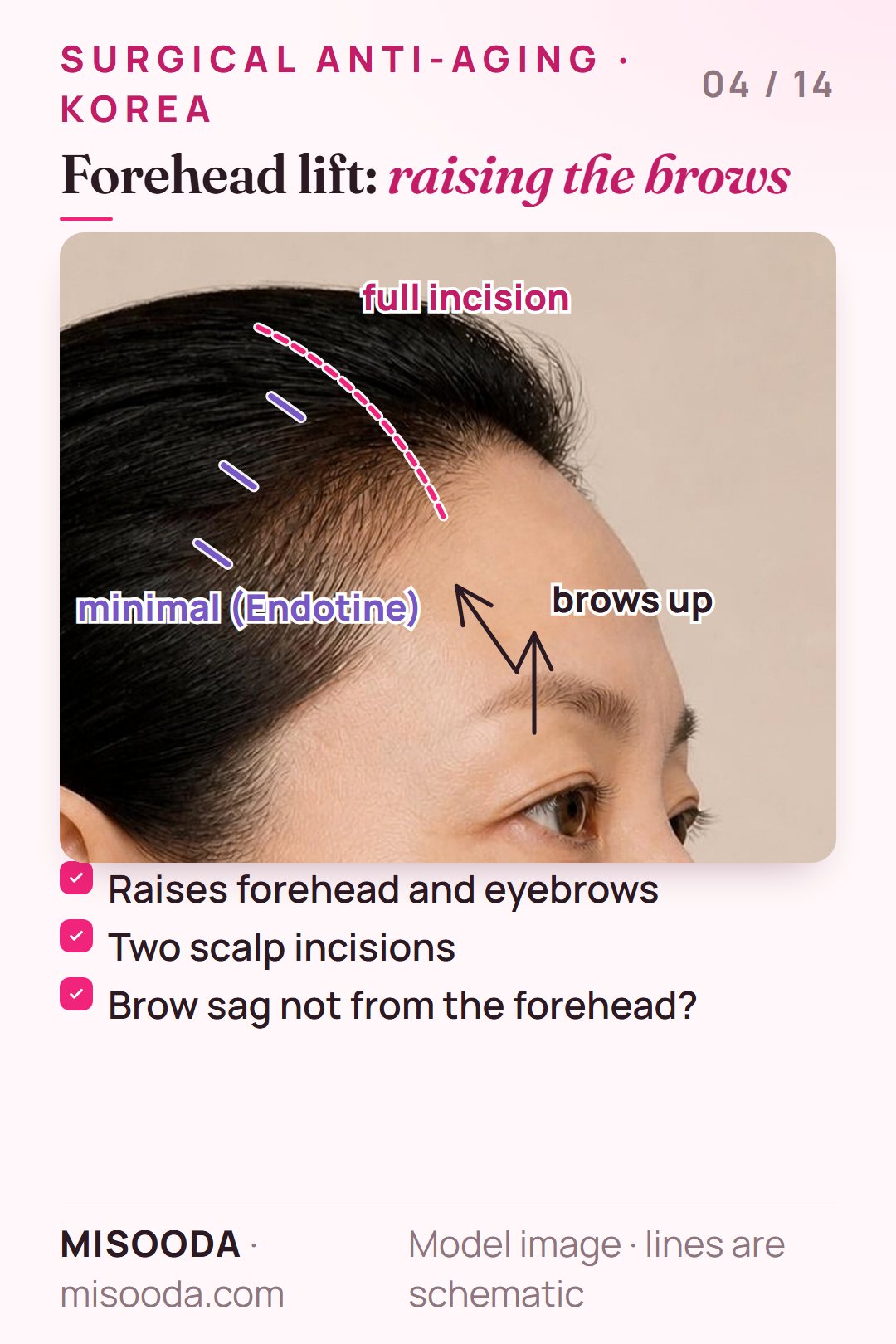Forehead lift in Korea: full-incision or minimal Endotine incisions on the scalp raise the forehead and eyebrows to improve wrinkles and vision
