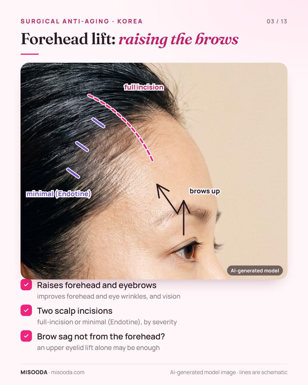 Forehead lift in Korea: full-incision or minimal Endotine incisions on the scalp raise the forehead and eyebrows to improve wrinkles and vision
